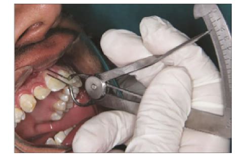 gingival thickness measurement|gingival tissue biotype.